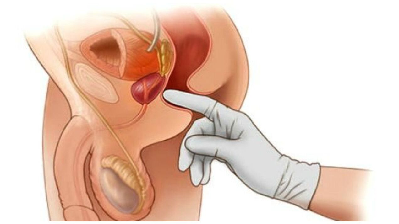 Massaggio prostatico per uomini